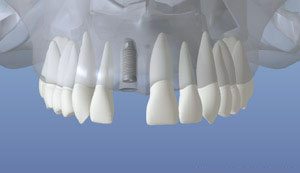 dentalimplant_04