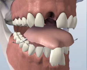 flipper teeth tooth implants retainer braces