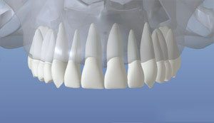 dentalimplant_01
