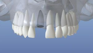 dentalimplant_02