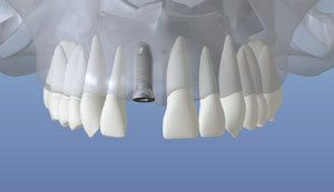 dentalimplant_05