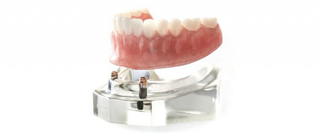 removable-vs-permanent-teeth-on-implants