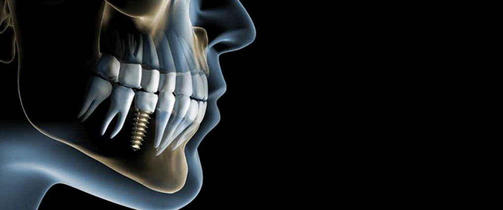 how-old-is-too-old-for-dental-implants