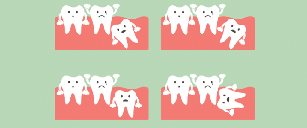 wisdom-teeth-extraction-what-to-expect-during-recovery-process