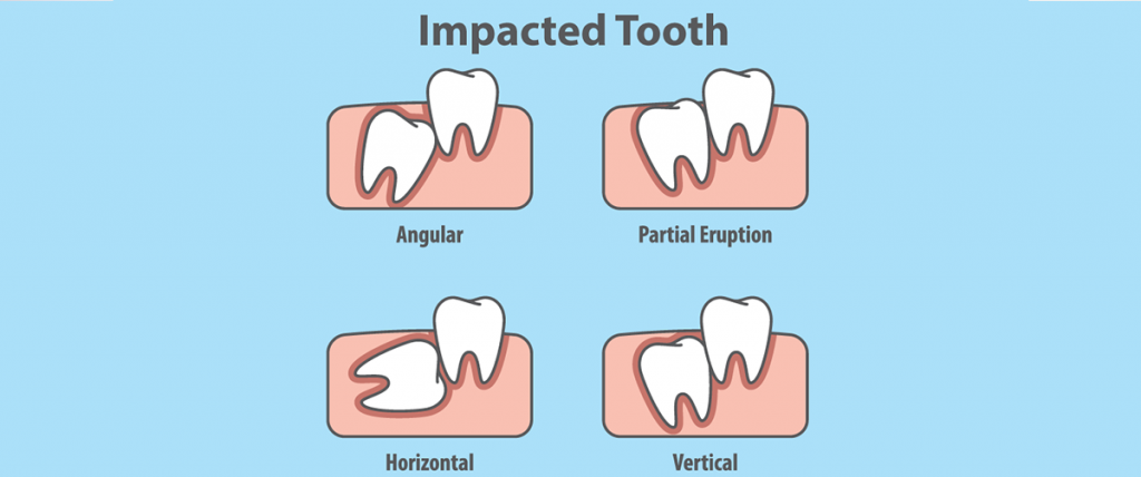 remove an impacted wisdom tooth