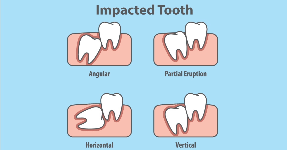 https://www.harbourpointeoralsurgery.net/wp-content/uploads/2017/11/impacted-tooth-og.png